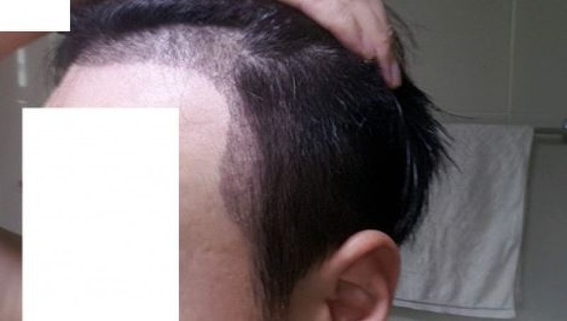 딱지제거후좌.JPG