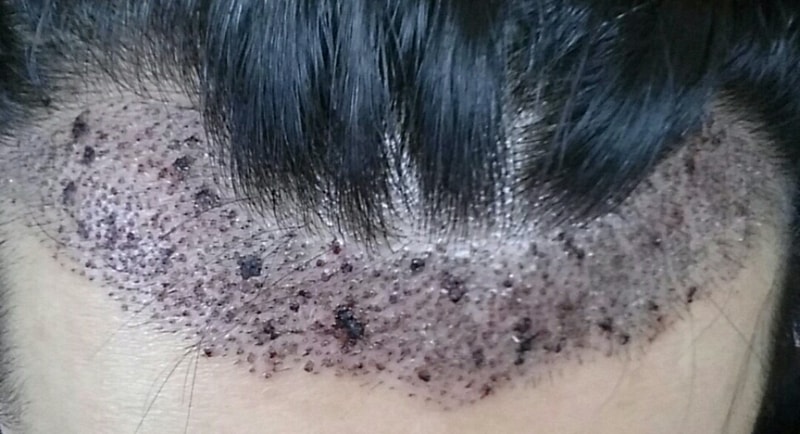 男士M发际线1300毛囊4日是手术后期。