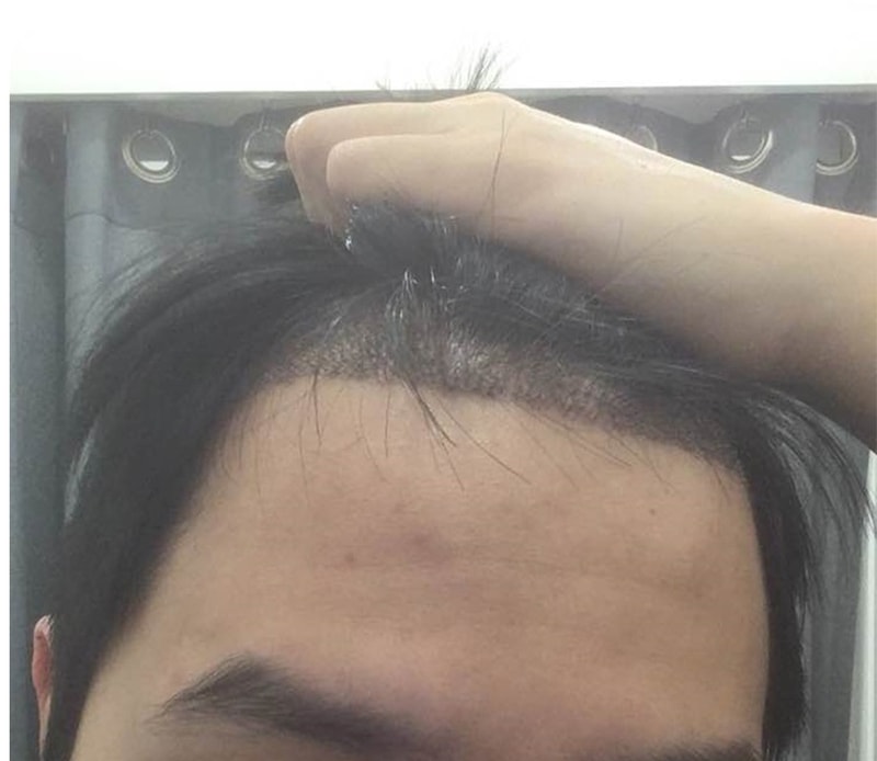 非切開で4ヵ月目になって、 頭が抜けました