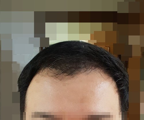 4. 수술4개월차.jpg