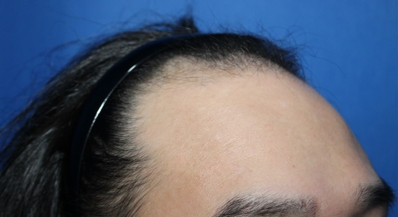 It's been half a year since I transplanted 3650 non-excisional hair