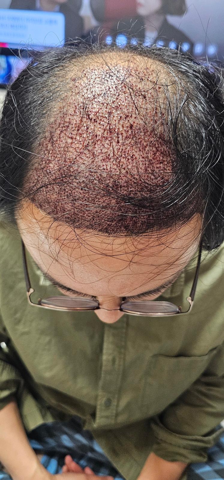 모발이식 1일차부터 10일차 입니다.