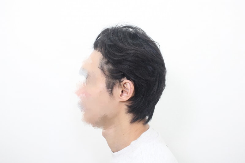 Sinsa-dong Mopro Clinic, Hair Transplant, 18th day review