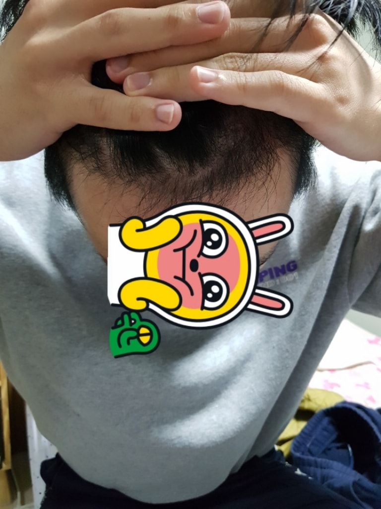수술 약 3개월 되기 전 후기 올립니다 !