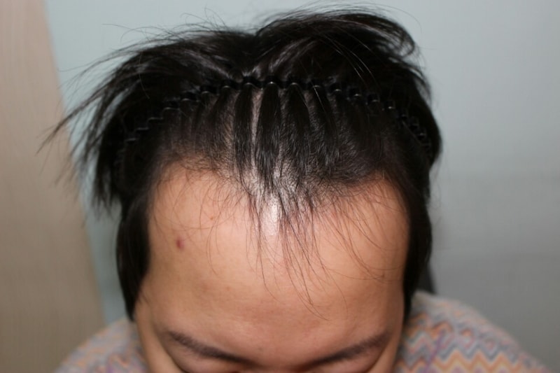 It's the 3rd month of Dr. Cho's incision!!