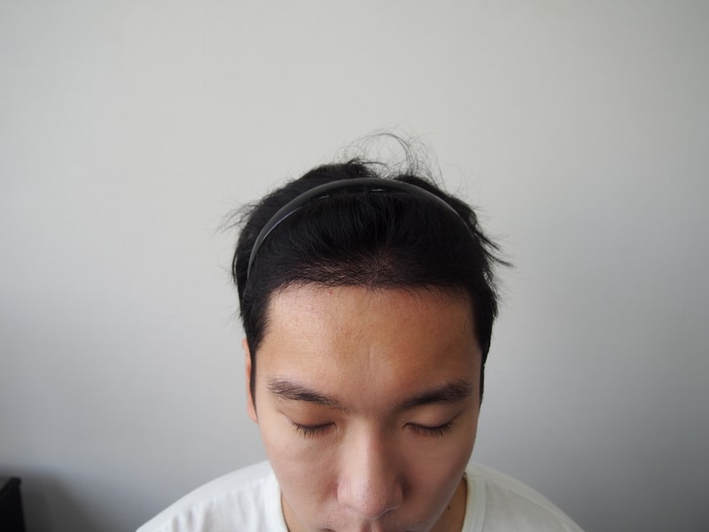 手术第4个月