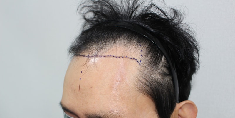 莫德罕议员毛发移植