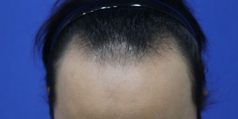 It's been 8 months since Mo'n'bleth's 4000-mo surgery