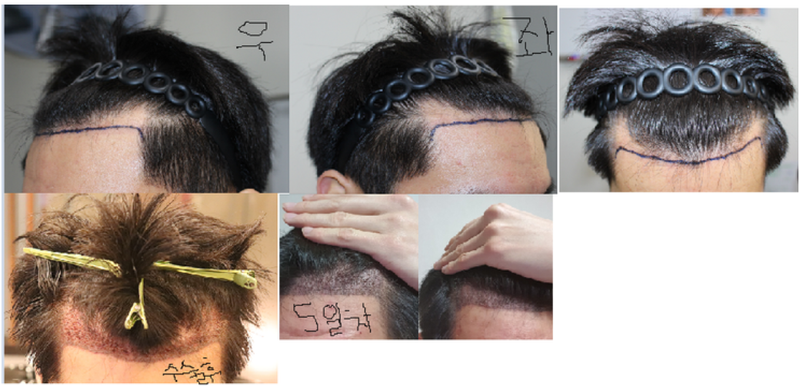 수술후.png