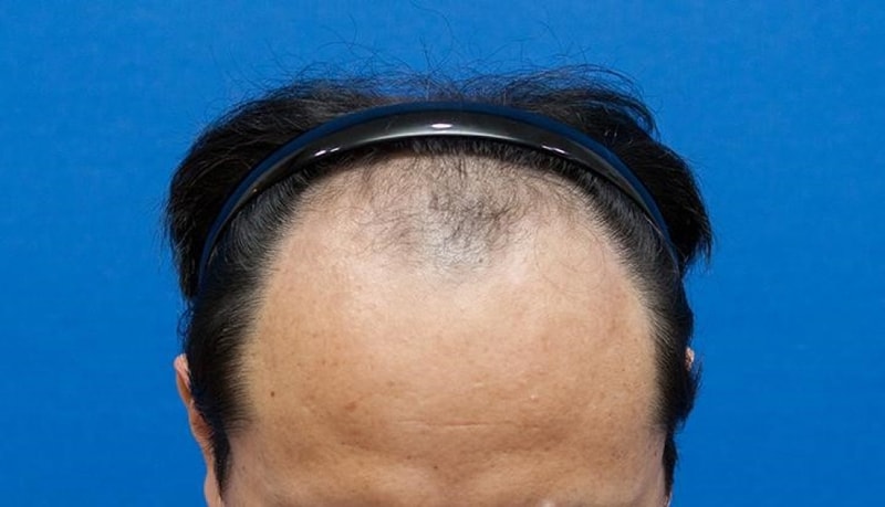이식전.jpg