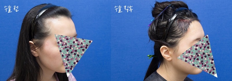 수술전_2.jpg