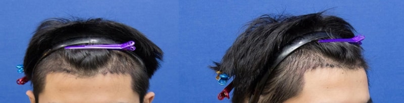 이식후7일.jpg