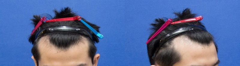이식전.jpg