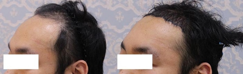 수술후_옆.jpg