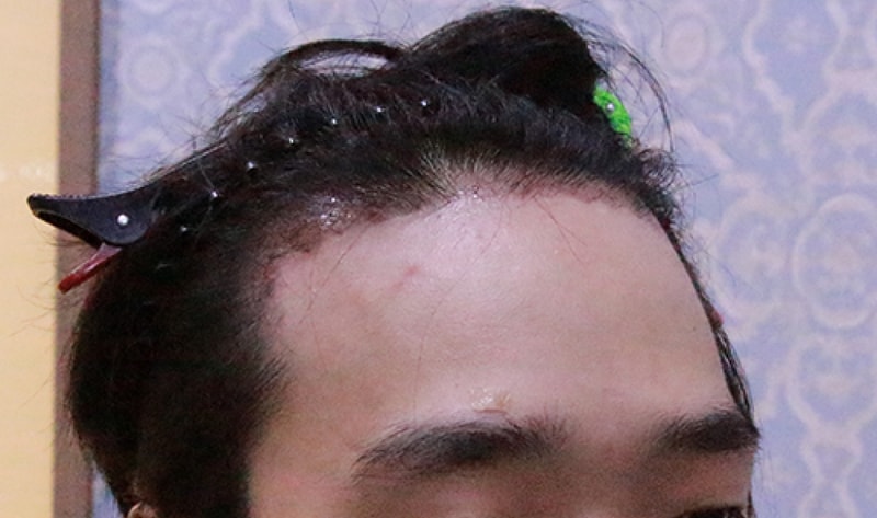 1달경과좀안됨4.jpg