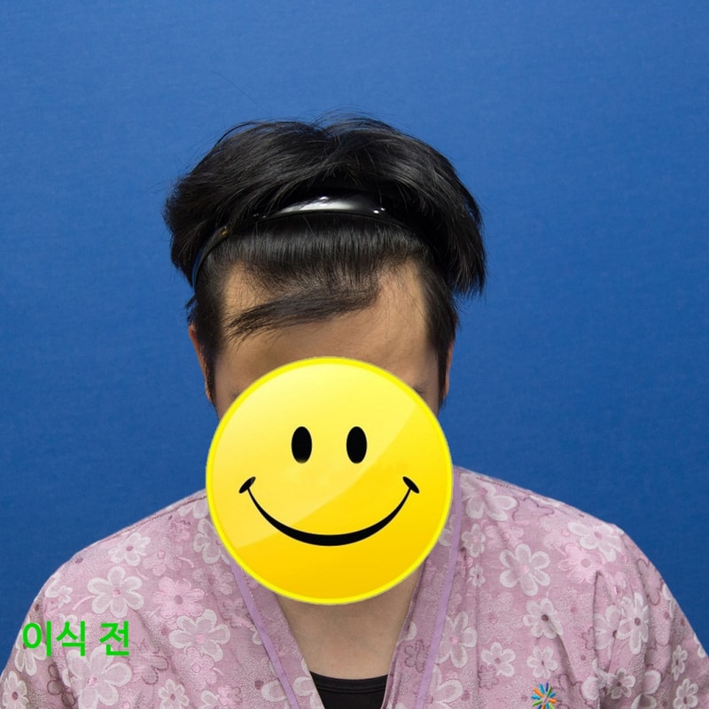 이식전.jpg
