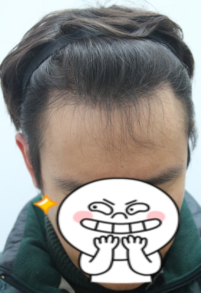 수술후1년최종.jpg