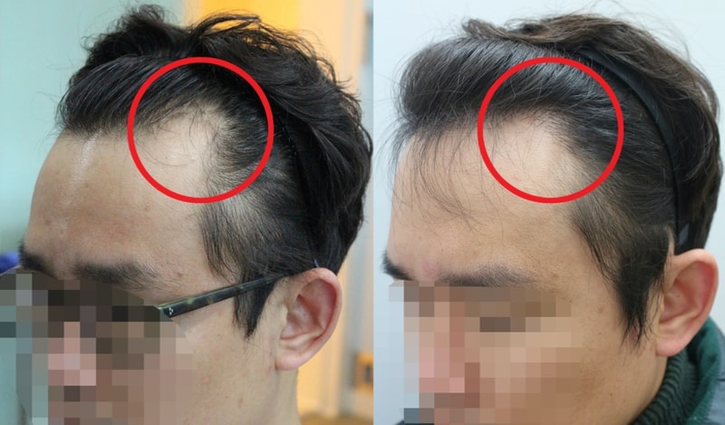 수술전후옆최종.jpg
