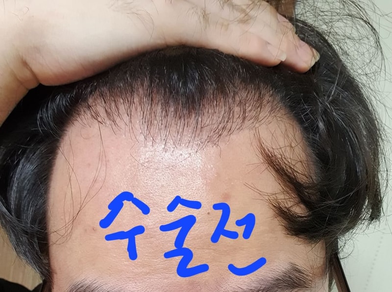 재수술 9개월차 후기입니다