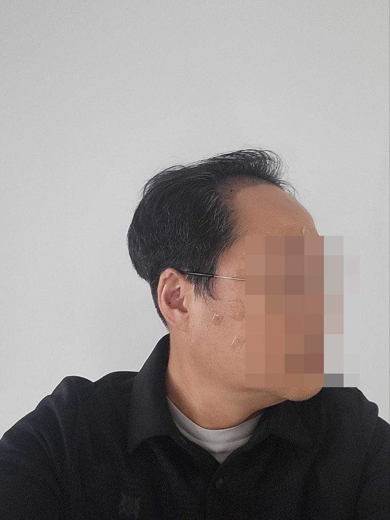 꾸미기20231023_문성용_수술_7일차.jpg