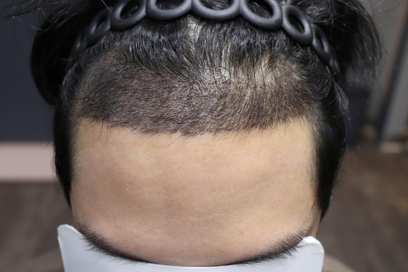 Review of Apgujeong Mobiang Nasal incision in Gwangju