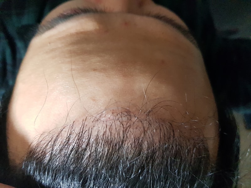 모션 1600모낭 3700모 6달후 한숨만