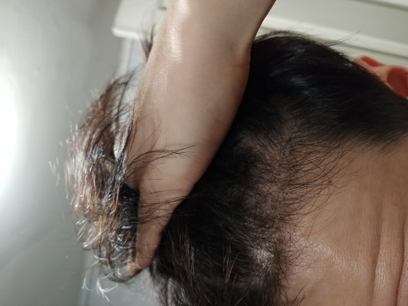 수술후 약 5개월 3주후 경과