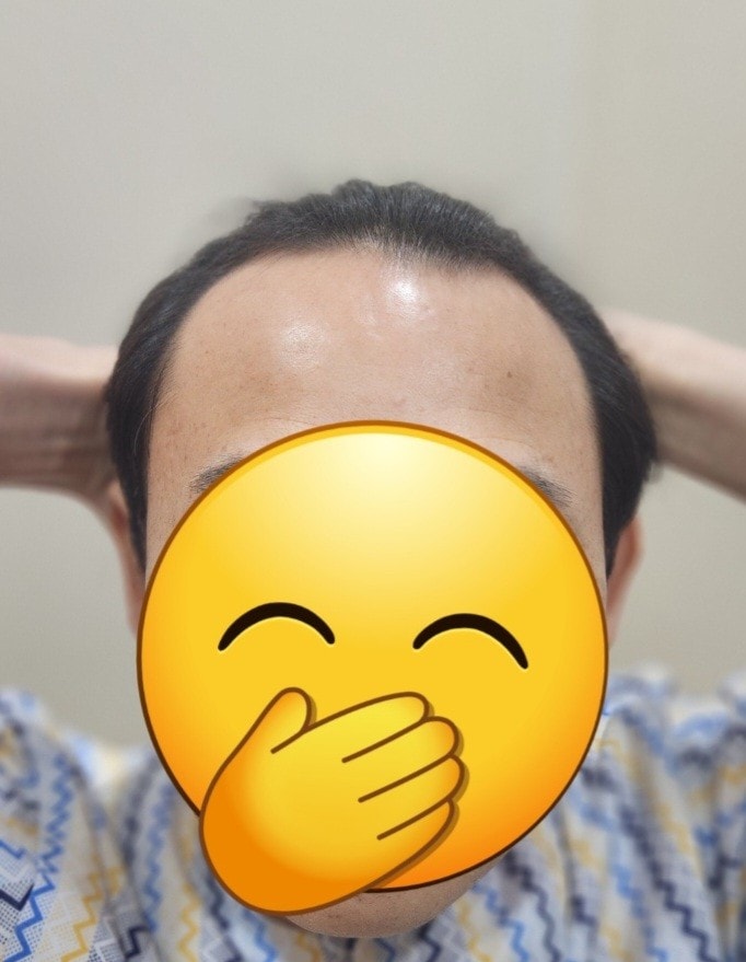 3500 Mo due to M-shaped forehead incision is now day 3!