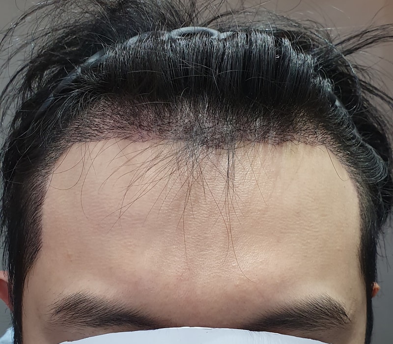수술_후_정면.jpg