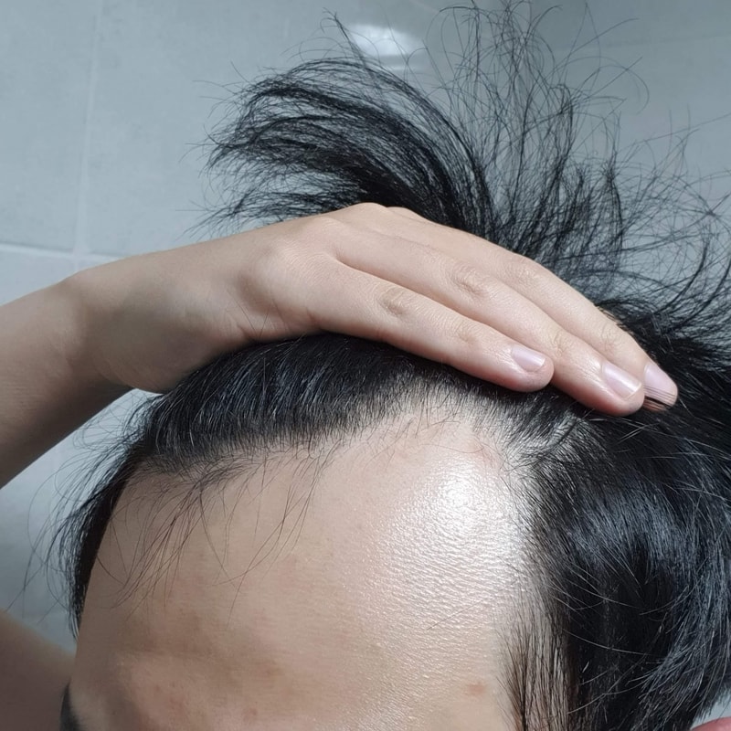 수술전오른쪽.jpg