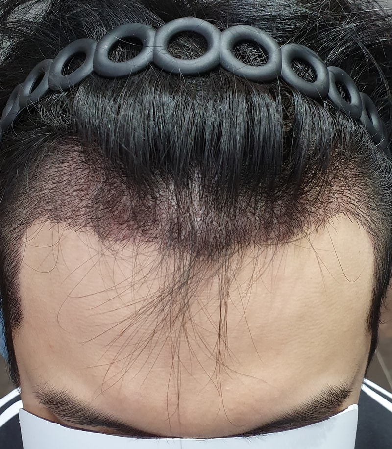 수술_후_정면_위.jpg