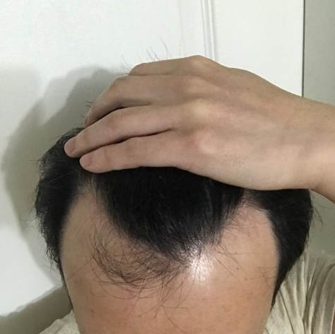 비포.PNG