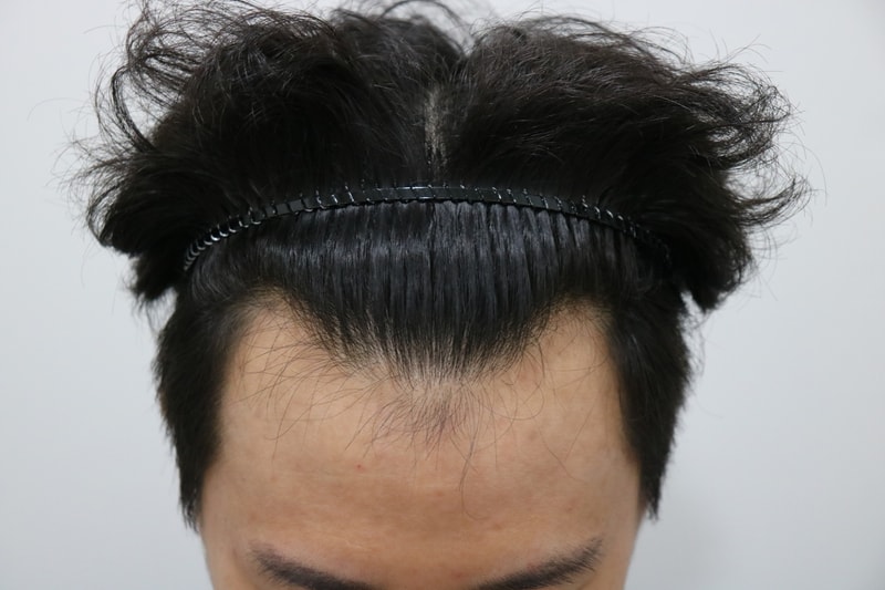 6개월 경과사진