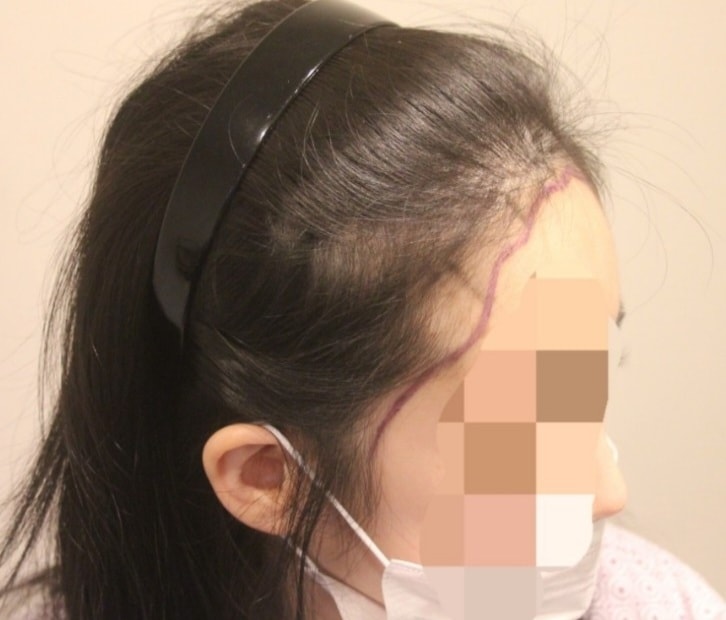 1441毛包毛髪移植して3ヶ月になりました！