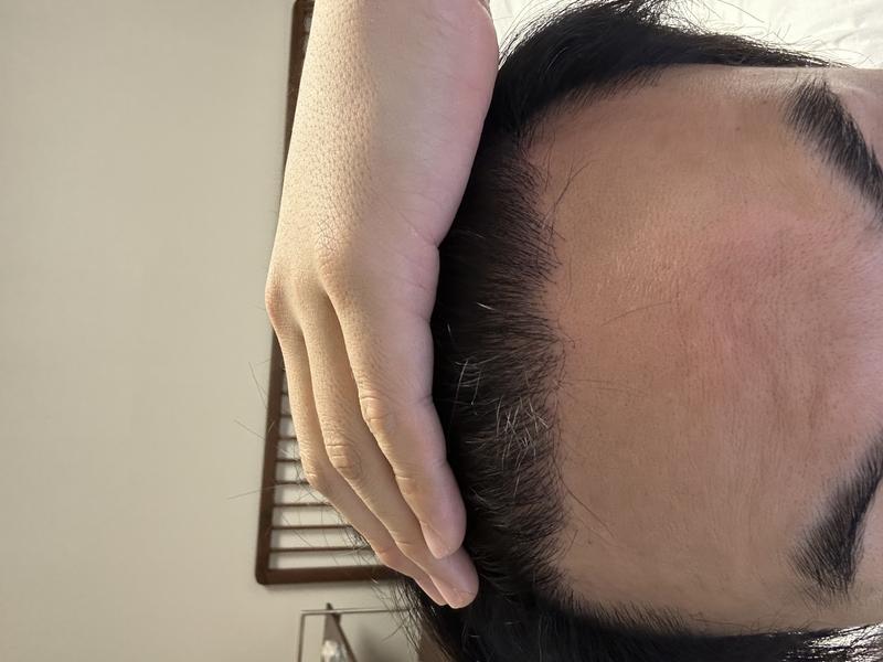 New Hair Seoul Director Kim Jin-oh's incision 2200 hair follicles 6 months later