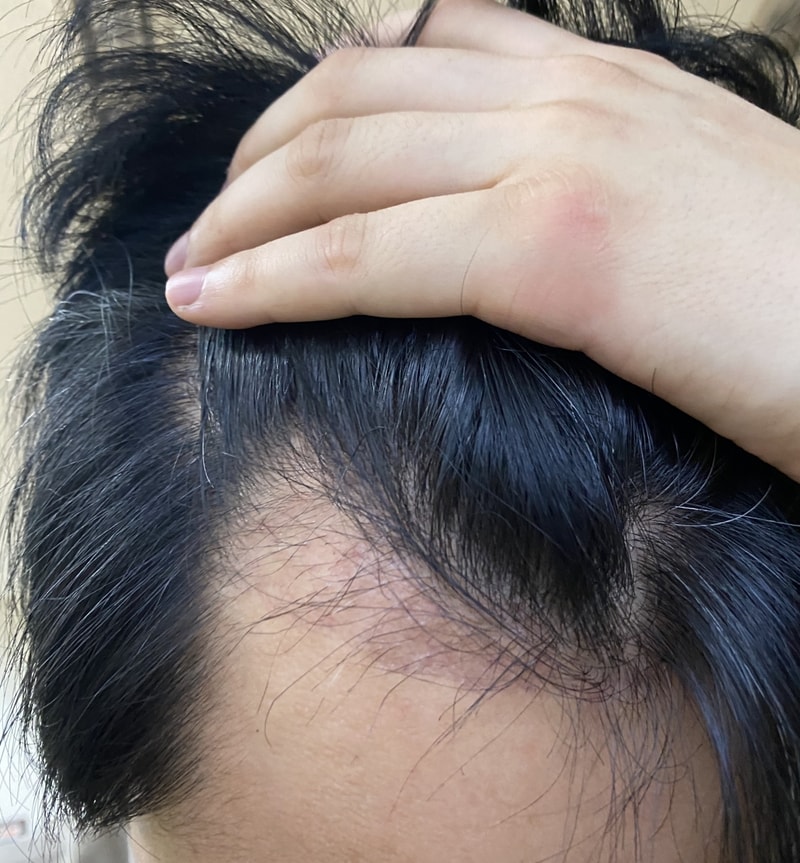非切開55日目、2000毛の暗黒期..