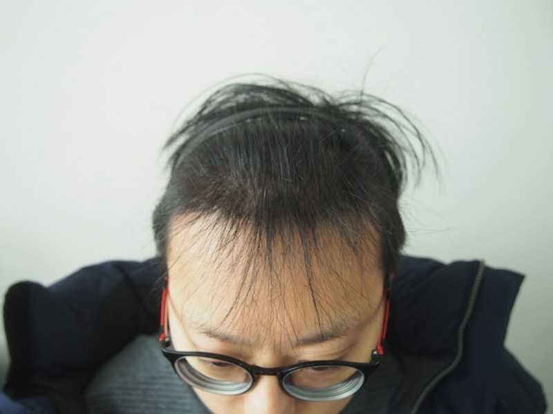 This is the 4th hair transplant