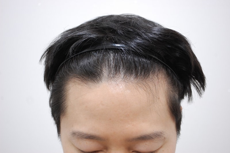 非切开1508毛手术后1年内变化