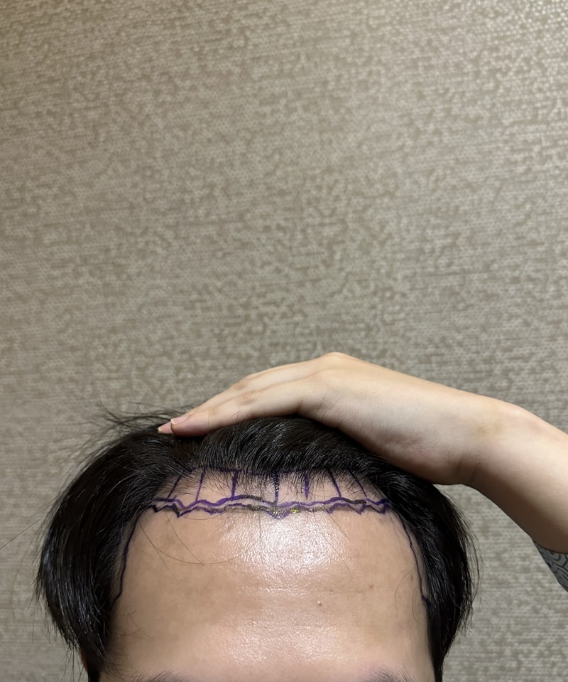 New Hair Day 3 Non-Cutting 1700 Hair follicle hair transplant review!