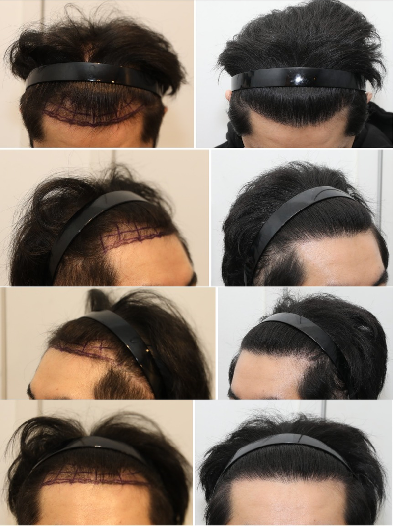 Late 1 year after hair transplant surgery