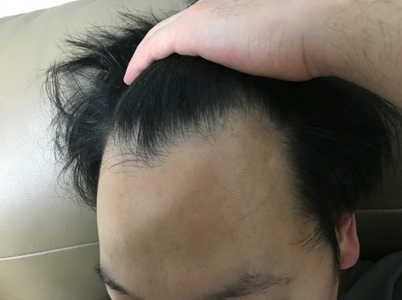 수술전.JPG