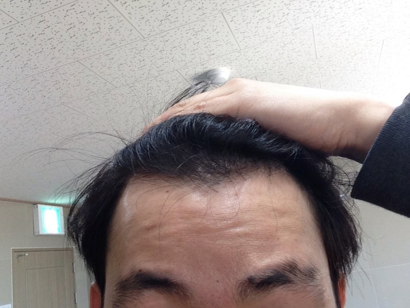 It's been a little over 100 days of JP hair transplantation. I can see it coming up now.