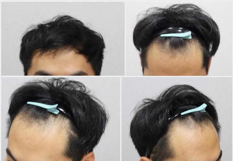 M자 절개 모발이식 4년 반 후기 (보강 1번 완료, 최종보강 예정)