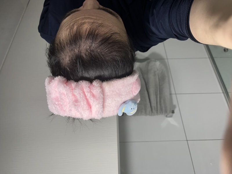 모발이식 4개월 찬데 어떤가요... 암흑기라 우울하네요ㅠㅠ