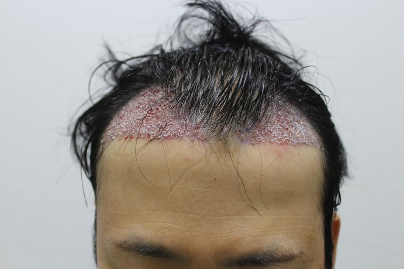 수술후.JPG