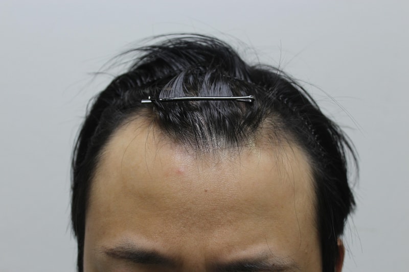 수술전.JPG
