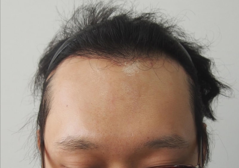 크기변환_수술전1.jpg