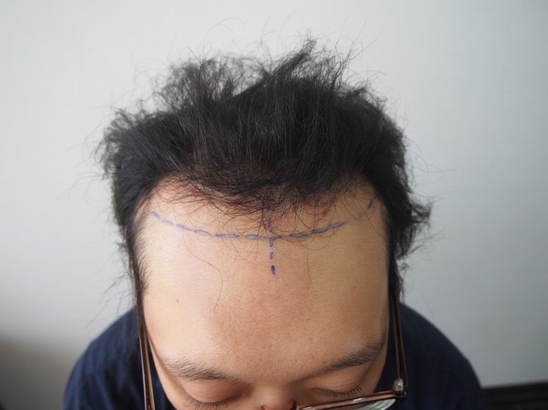 크기변환_수술전2.JPG