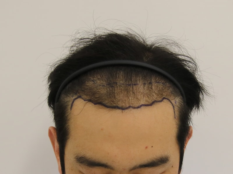 부산 맘모스 헤어라인 모발이식 1년 4개월 후기