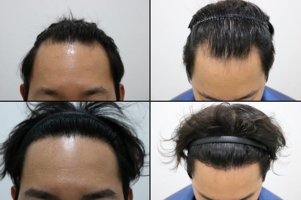 M자형탈모 비절개 4044모 이식 9개월차 후기입니다.